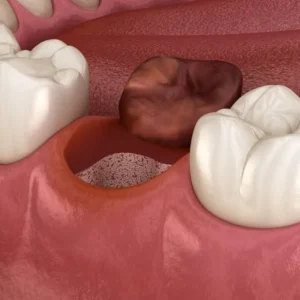 SafeEndo Socket Cure - Image 3