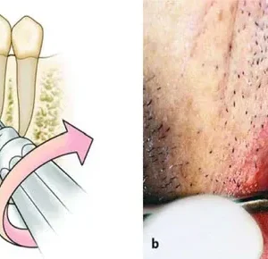 GDC Root Elevator Set Of 9 In Pouch (RESP9) - Image 4