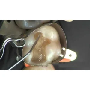 GDC Restore Instrument - Applica - Image 4